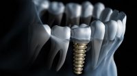 Implantul dentar si reprezentarea nivelului profesional