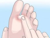 Efectele tratamentelor cu cortizon asupra micozei piciorului