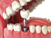 Implant dentar și coroană: această combinație este potrivită pentru dvs.?