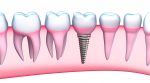 Care sunt etapele si beneficiile unui implant dentar?