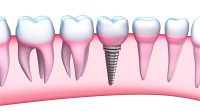 Care sunt etapele si beneficiile unui implant dentar?