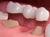 Garantie 10 ani la puntile dentare