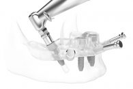 Ghidul chirurgical: o metodă inovatoare de plasare a implanturilor dentare, fără intervenție chirurgicală