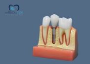 Implant Dentar ghidat digital