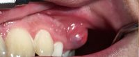 Infecții ale cavității orale: abcesul gingival și candidoza orală