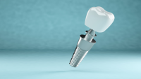 Mituri despre implanturile dentare
