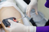 Scleroterapia și terapia laser – cele mai eficiente metode de tratament pentru venectazii (vase superficial vizibile)