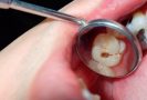 Gangrena dentara – dusmanul tacut