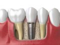 Tot ce ar trebui sa stiti despre implantul dentar - implant dentar pret