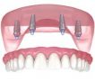 Ce inseamna la GermanDent un implant dentar ieftin?